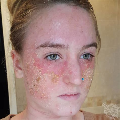 Woman Became A Hermit After Eczema Made Her Embarrassed To Be Seen In