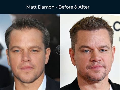 Celebrity Hair Transplants Photos Before And After