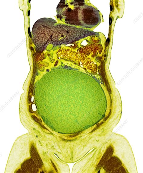 Ovarian Cancer Ct Scan Stock Image C0509697 Science Photo Library