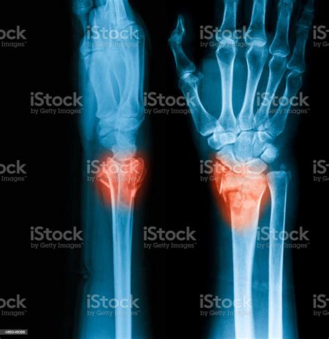 Xray Image Of Wrist Joint Ap And Lateral View Stock Photo Download