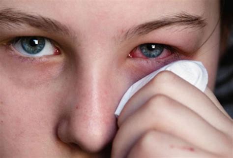 Redness Pain Swelling In Eyes Can Be Infection