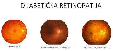 Oftalmološka Poliklinika Dr Balog Stranica 3 Od 3