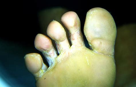 SUPERFICIAL FUNGAL INFECTIONS Tinea Pedis Athlet S Foot Picture