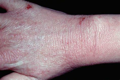 Differential Diagnoses Hand Rashes Gponline