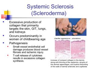 Shifts in these domains have the ability to affect the entire market and cannot be mitigated by changing around positions within a portfolio of public equities. Scleroderma | Myositis Support and Understanding