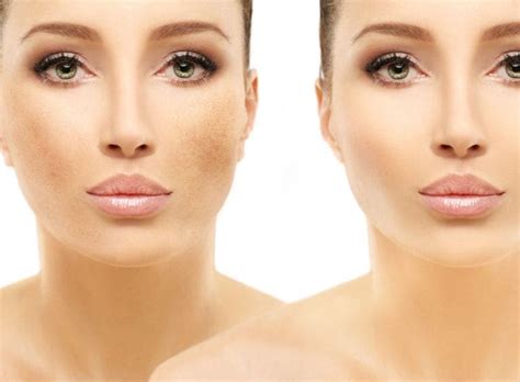 Pigmentation Treatment Laser Skin Solutions