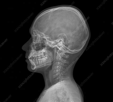 Normal Childs Head X Ray Stock Image F0033523 Science Photo
