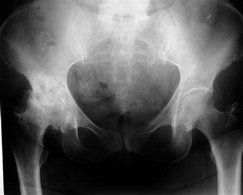 Radiograph Of Osteoarthritis In Right Hip Joint With Moderate Loss Of Download Scientific