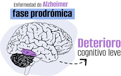 Fases Del Alzhéimer Roche Pacientes