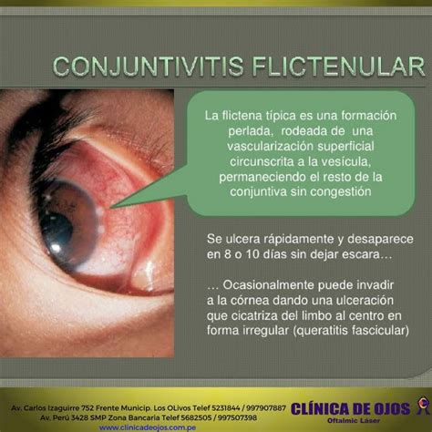Clínica de Ojos Oftalmic Láser CONJUNTIVITIS FLICTENULAR