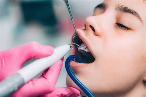Limpiezas Dentales Regulares Dr Diler Your Friendly Dental Clinic
