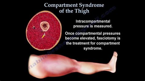Thigh Compartment Syndrome Everything You Need To Know Dr Nabil