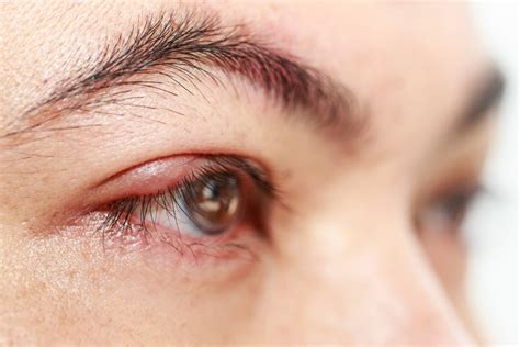 Blepharitis What You Should Know Keamy Eye And Laser Centre