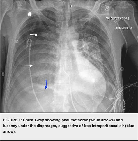 Figure 1 From The Forgotten Complication Of Nasogastric Tube Insertion