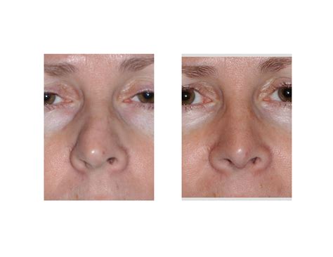 Case Study Rhinoplasty For The Crooked Nose Explore Plastic Surgery