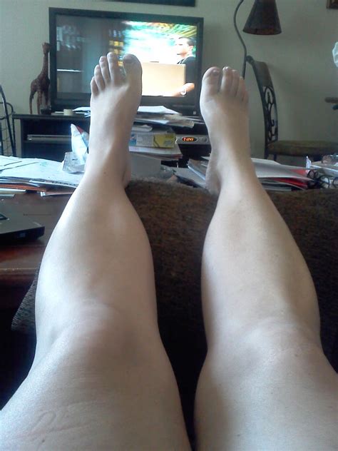 (5) left foot, right foot, left foot, breathe rev. Life with Lupus: Swelling.....should I worry?