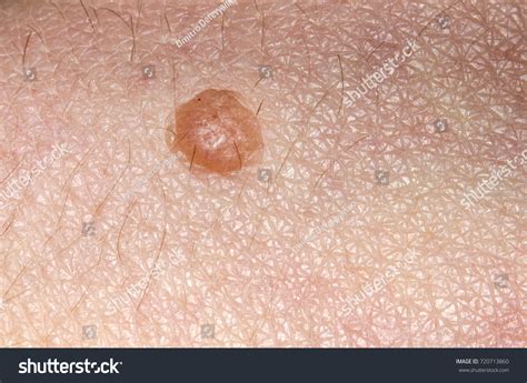 Blister On Skin Benign Tumor On Stock Photo 720713860 Shutterstock