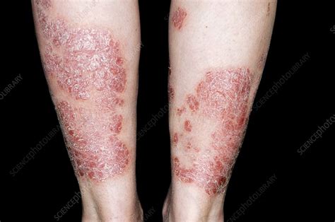 Plaque Psoriasis On The Legs Stock Image C0117480 Science Photo