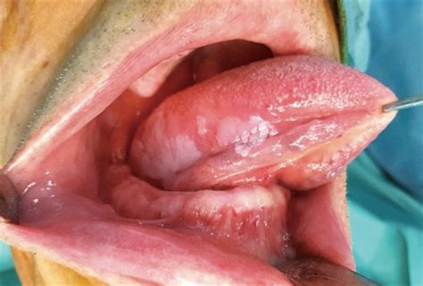 If the feeling doesn't let up or. Tongue Cancer Pictures. What does tongue cancer look like?