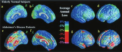 Average Gray Matter Loss Rates In Healthy Aging And Ad The Maps Show