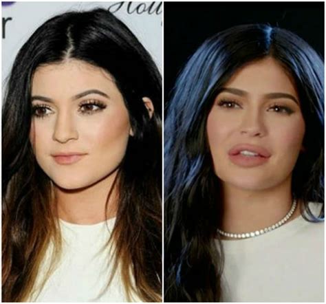kylie jenner s lips before and after pictures of her pout