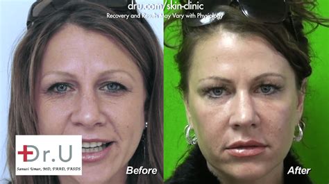 Video Dysport To Treat Frown Lines Between Brows In Redondo Beach Los