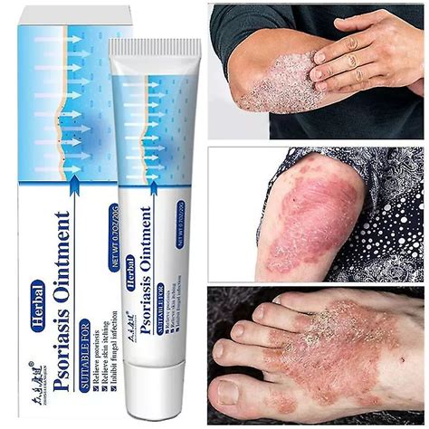 Small Classic Sl Chang Antibacterial Anti Itch Psoriasis Cream
