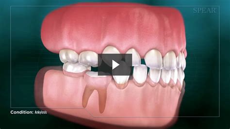 Ankylosis Cosmetic Dentistry