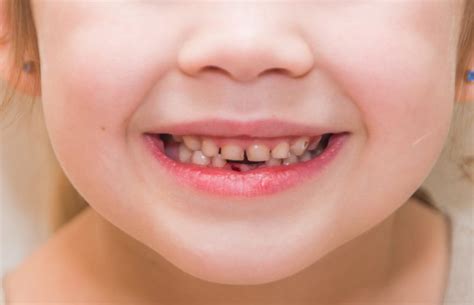 Causes Of Bleeding Gums In Children Anchorage Pediatric Dentistry