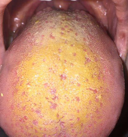 Your yellow tongue stock images are ready. My Tongue has a Yellow Coating of Fur WTF! - BabyCenter