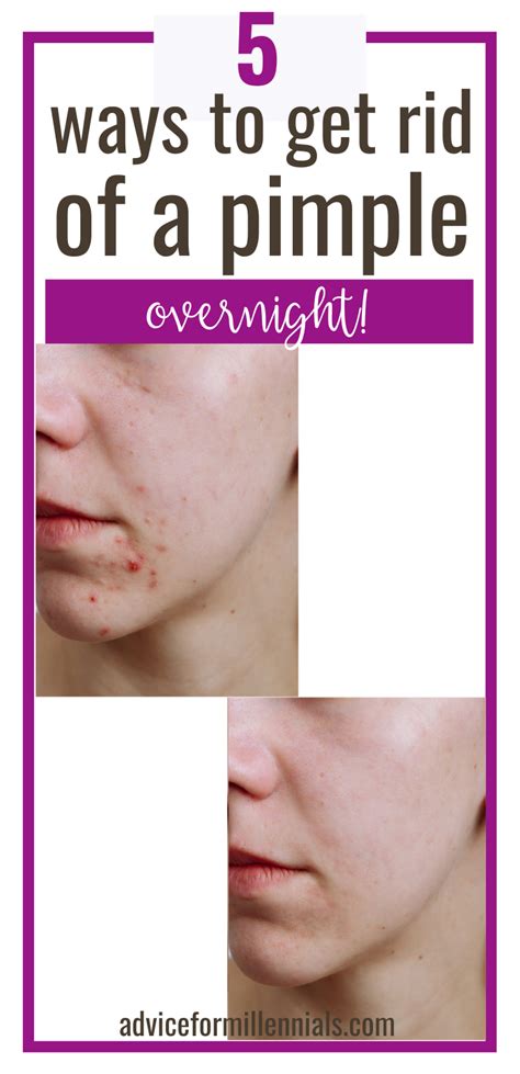 Pimple Remedies Overnight In 2021 Pimples Overnight Remove Pimples