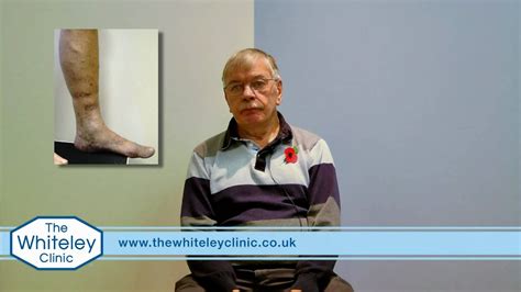 Venous Eczema And Varicose Veins Treated By The Whiteley Protocol® Eczema Helpline