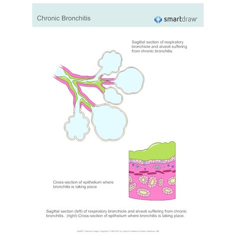 Chronic Bronchitis