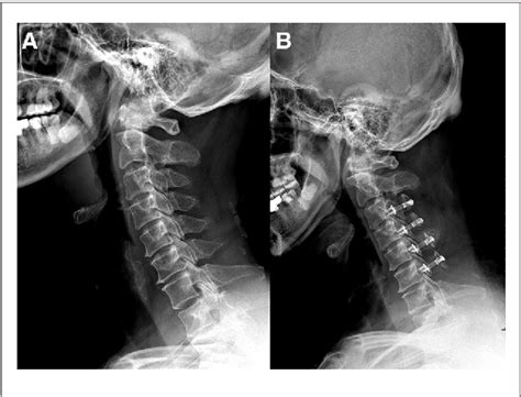 Figure 1 From The Discrepancy Between Preoperative Cervical Sagittal