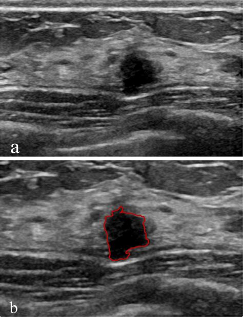 Adenosis Classified As Bi Rads 4a A Ultrasound Revealed A Solid