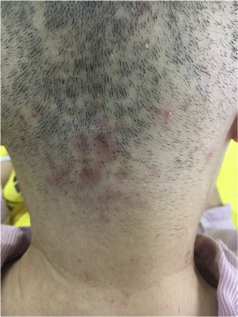 The Confluent Lesions Are Shown On The Occipital Area Of The Scalp And