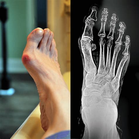 Bunion Symptoms Diagnosis And Treatment Health And Dsease