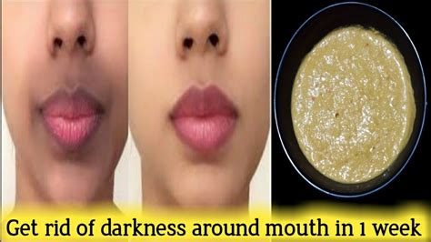 Remove Dark Black Patches Dark Spots Hyperpigmentation Around Mouth