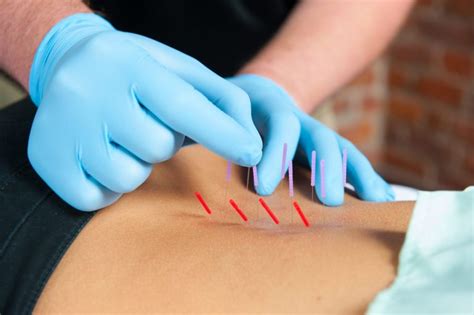 dry needling physical therapy clinic of lafayette