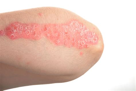 Psoriasis Sechs Wichtige Fakten über Verbreitete Hautkrankheit