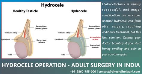 Hydrocele Surgery In India Get Better And More Wide Ranging Care