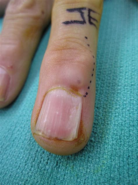 Hard Lump On Finger Joint Under Skin