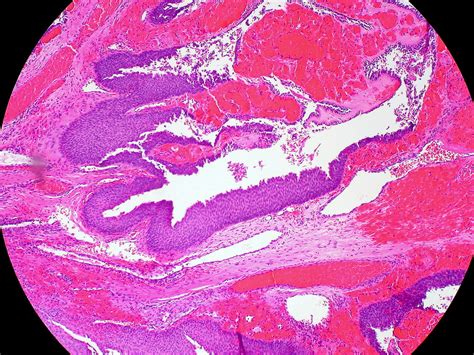 Exophytic Papilloma Of Nasal Septum Ed Uthman Flickr