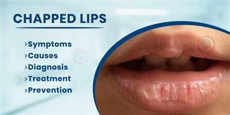 Chapped Lips Symptoms Causes Diagnosis Treatment And Prevention
