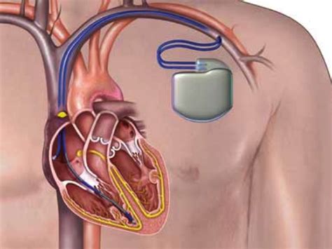Your doctor will decide what type of pacemaker you need based on your heart condition. Implantable Cardioverter Defibrillator (ICD) - Dr Matthew ...