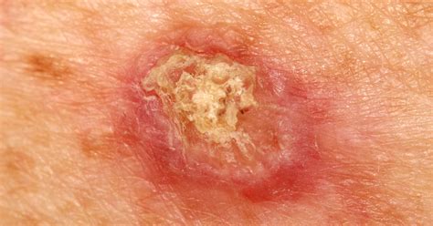 Squamous Cell Carcinoma Causes Symptoms Prevention Diagnosis Treatment And Prevention