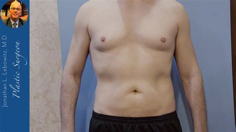Define The Muscles For Perfect Results D Hi Def Vaserlipo Gynecomastia Surgery By Dr Lebowitz
