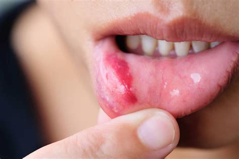Feridas na boca conheça os tipos causas e tratamentos