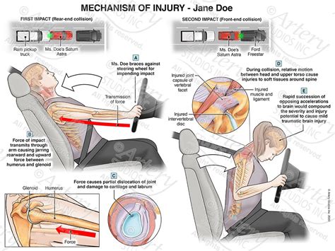 Motor Vehicle Accident Artery Studios Medical Legal Visuals