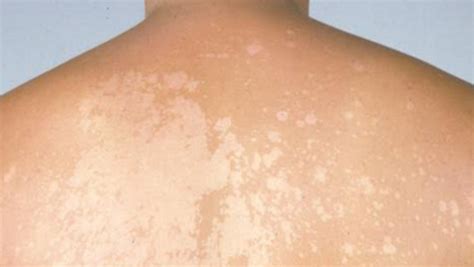 Weiße Flecken Auf Der Haut Gefährlich Mit Bildern Lacaleya